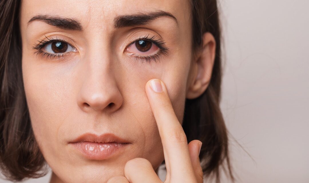 Can Dry Eye Get Better on Its Own?