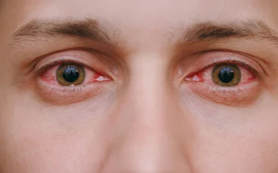 Red, Itchy, Watery Eyes? It Could Be Pink Eye